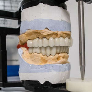 Implant basal et dents devitalisées