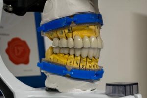 restauration dentaire prothese metal ceramique