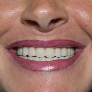implant-ihdedental-bulgarie-medica-1-1