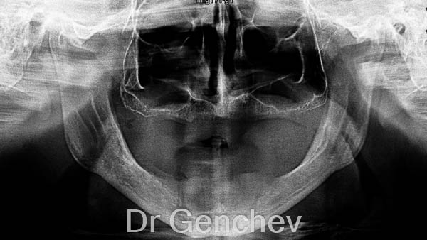 édentation et perte d'os totale