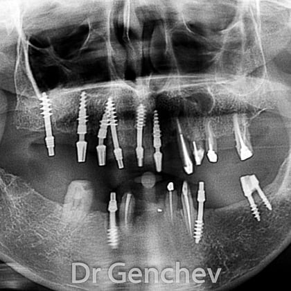 restauration dentaire avec implant basal pour parodontite