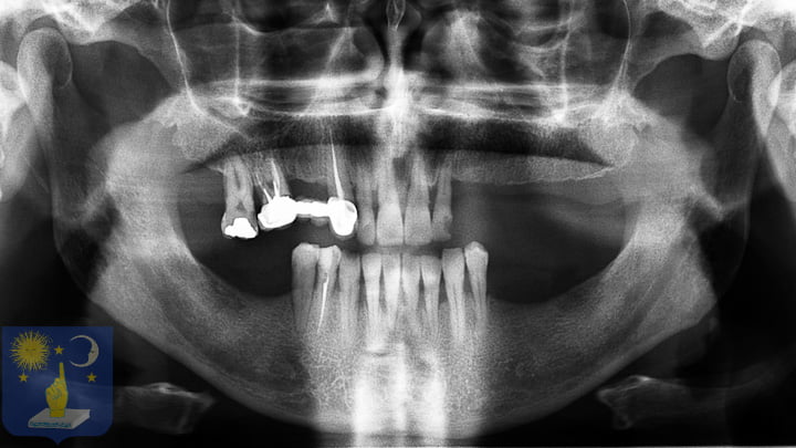radio panoramique implant basal