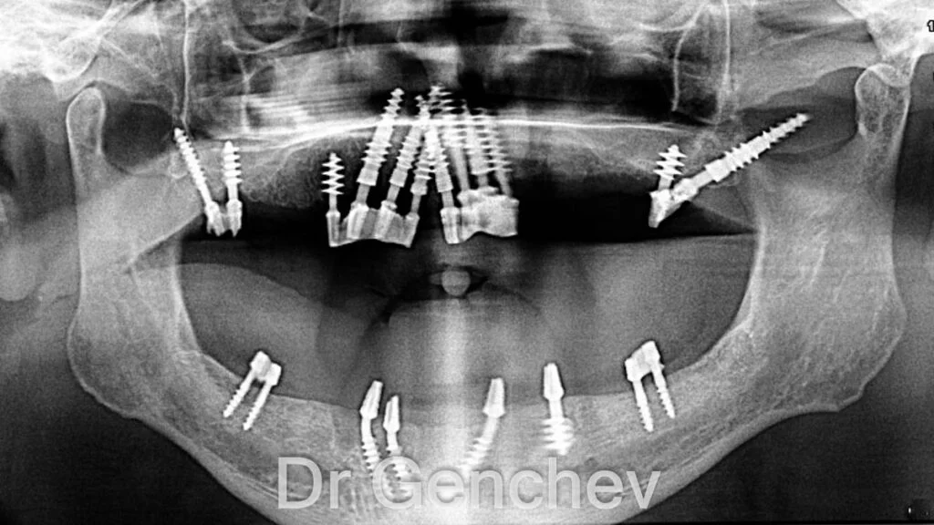 Dr Genchev implantologie basale