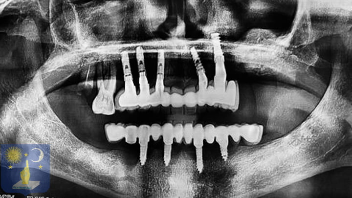 Implant dentaire cherif