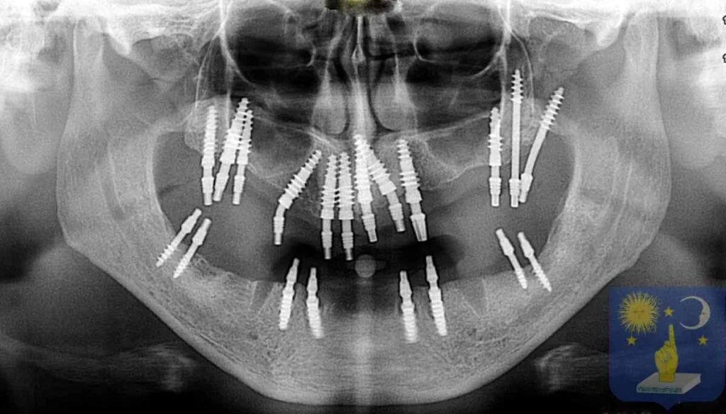 Dr Genchev implant basal pterygoidien
