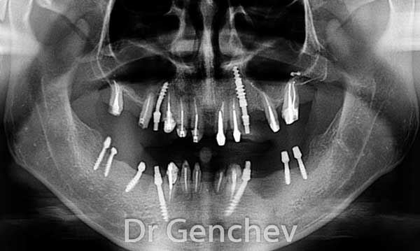 implant basal et dents devitalisees