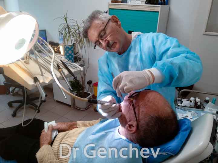 Dr Genchev pose un implant basal