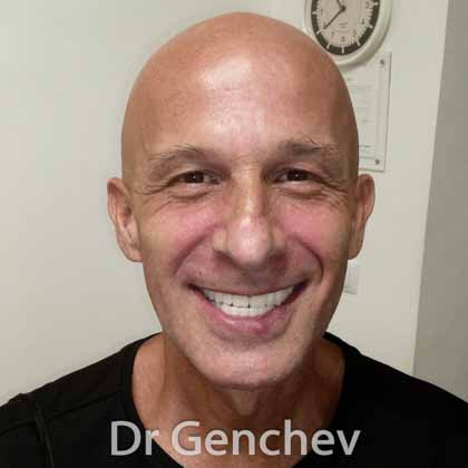 Patient de France pour restauration dentaire avec implant basal 