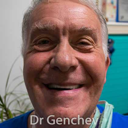 Patient de France edente pour restauration dentaire avec implant basal