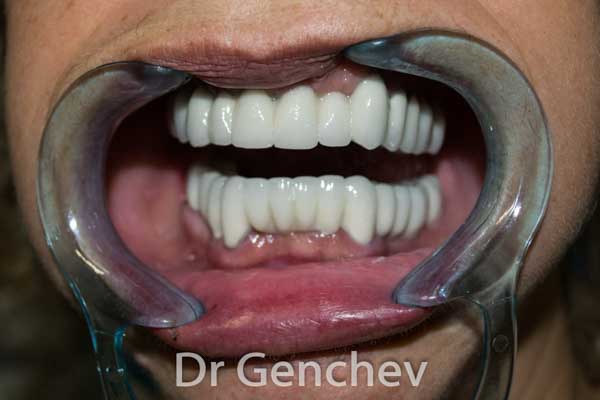 restauration dentaire avec implant basal pour parodontite et edentation